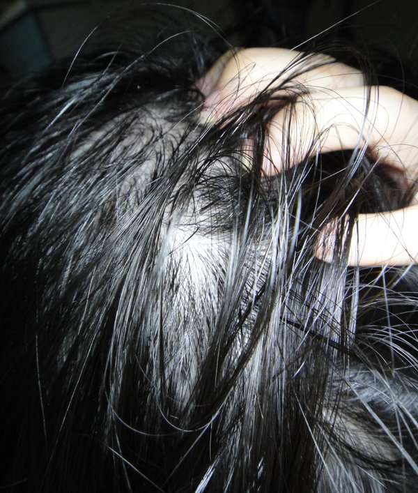 女人 知己 試用 大隊 Charm 卉紅 生技 頭皮 護理 精萃 掉頭髮 頭皮出油 髮量少 頭皮痛 頭皮長痘痘 圓形禿 雄性禿 頭髮變細 髮量少露出頭皮 脂漏性毛囊炎 染髮後頭皮發炎 chialo