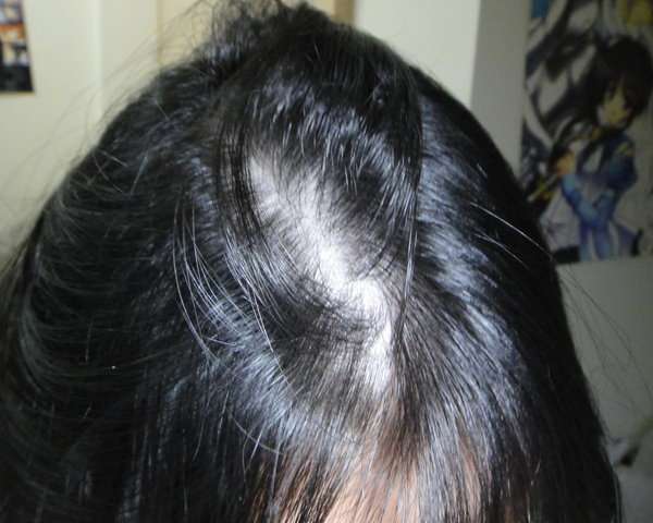 女人 知己 試用 大隊 Charm 卉紅 生技 頭皮 護理 精萃 掉頭髮 頭皮出油 髮量少 頭皮痛 頭皮長痘痘 圓形禿 雄性禿 頭髮變細 髮量少露出頭皮 脂漏性毛囊炎 染髮後頭皮發炎 chialo