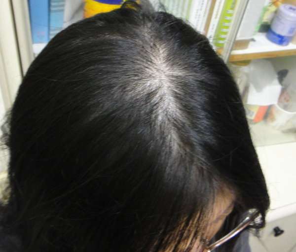 女人 知己 試用 大隊 Charm 卉紅 生技 頭皮 護理 精萃 掉頭髮 頭皮出油 髮量少 頭皮痛 頭皮長痘痘 圓形禿 雄性禿 頭髮變細 髮量少露出頭皮 脂漏性毛囊炎 染髮後頭皮發炎 chialo