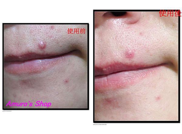  macy金縷梅爽膚淨荳面膜