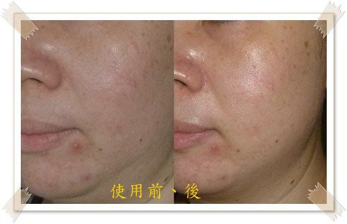 Hey蘋果肌女孩蕾絲拉提式面膜