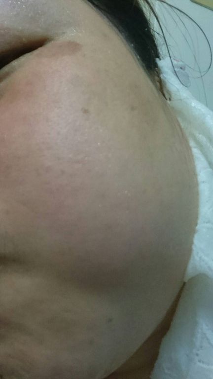 Hey蘋果肌女孩蕾絲拉提式面膜