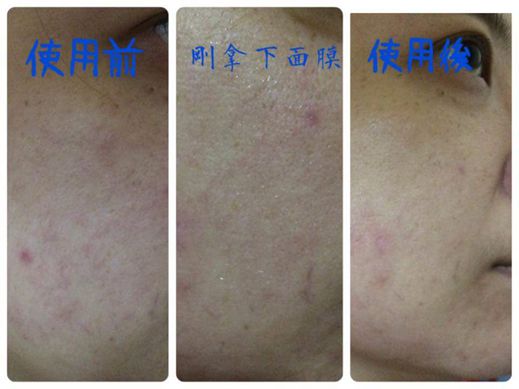 Hey蘋果肌女孩蕾絲拉提式面膜