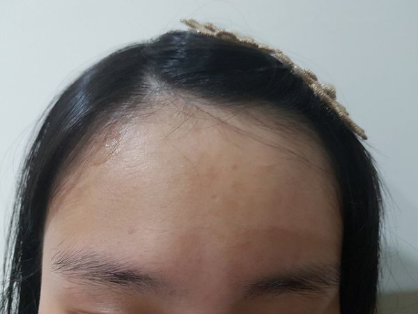 AMIINO安美諾高效抗痘凝膠