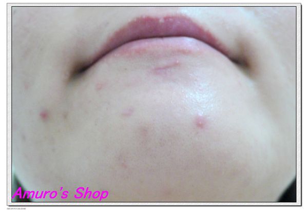 AMIINO安美諾高效抗痘凝膠