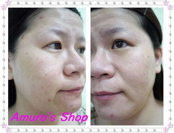 AMIINO安美諾高效抗痘凝膠