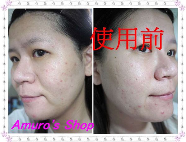 AMIINO安美諾高效抗痘凝膠