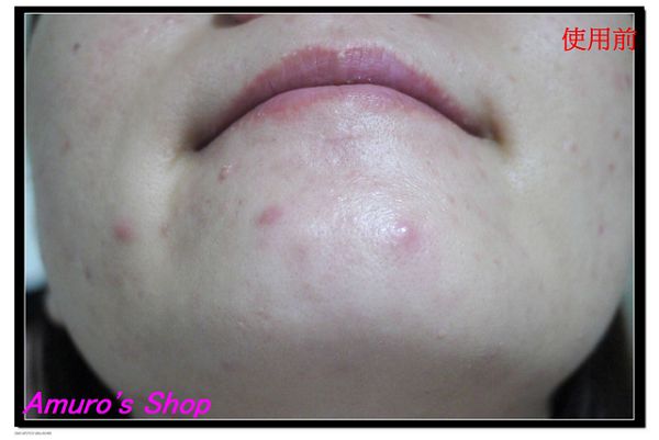 AMIINO安美諾高效抗痘凝膠