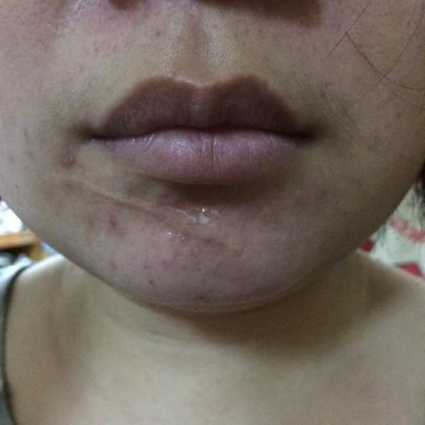 AMIINO安美諾高效抗痘凝膠