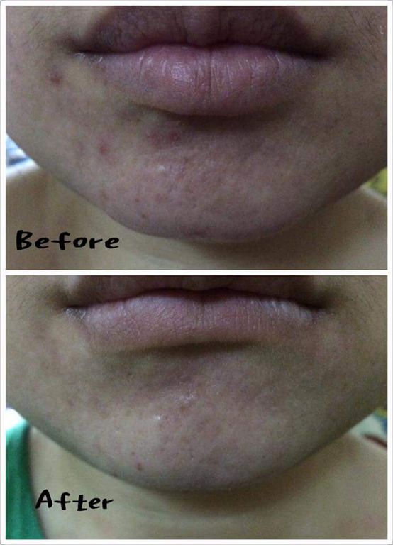 AMIINO安美諾高效抗痘凝膠