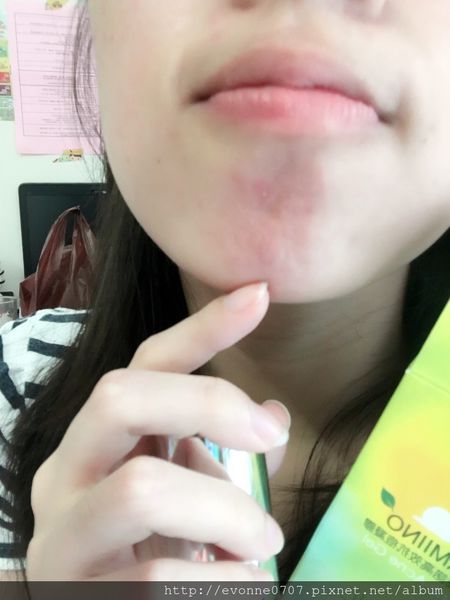 AMIINO安美諾高效抗痘凝膠