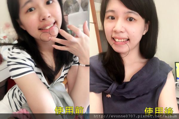 AMIINO安美諾高效抗痘凝膠