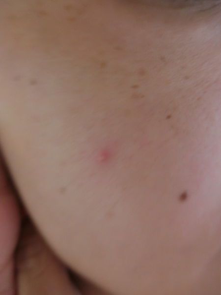 AMIINO安美諾高效抗痘凝膠