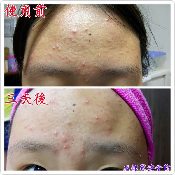 AMIINO安美諾高效抗痘凝膠