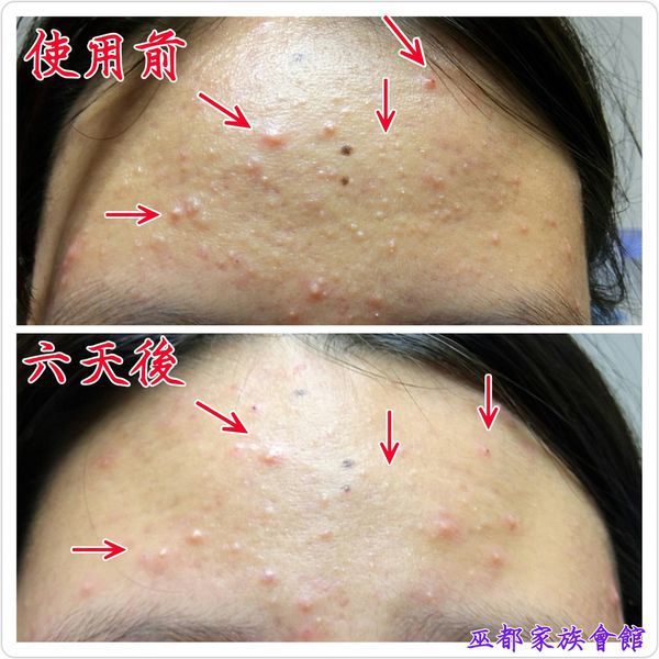 AMIINO安美諾高效抗痘凝膠