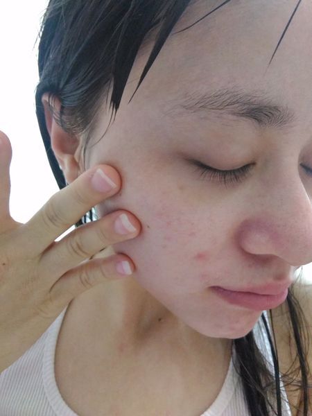 AMIINO安美諾高效抗痘凝膠