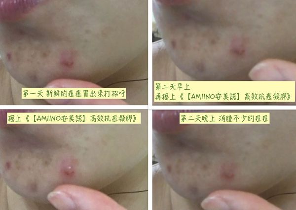 AMIINO安美諾高效抗痘凝膠