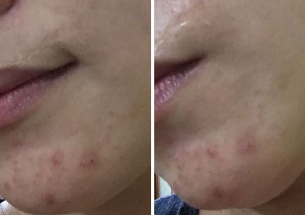 AMIINO安美諾高效抗痘凝膠