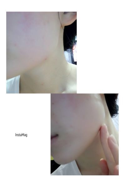 AMIINO安美諾高效抗痘凝膠