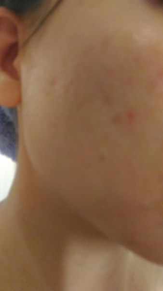 AMIINO安美諾高效抗痘凝膠