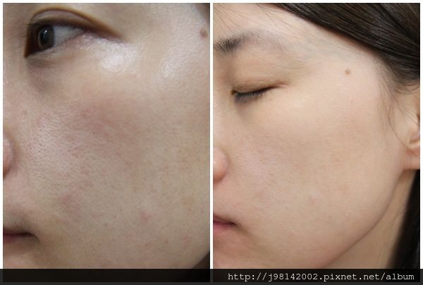 AMIINO安美諾高效抗痘凝膠