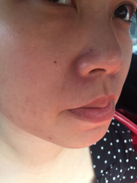 AMIINO安美諾高效抗痘凝膠