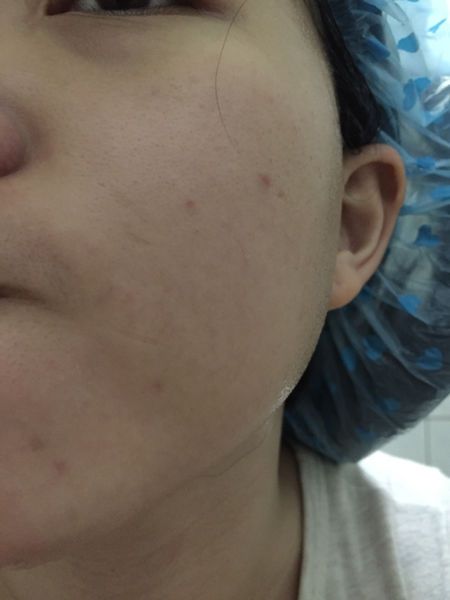 AMIINO安美諾高效抗痘凝膠