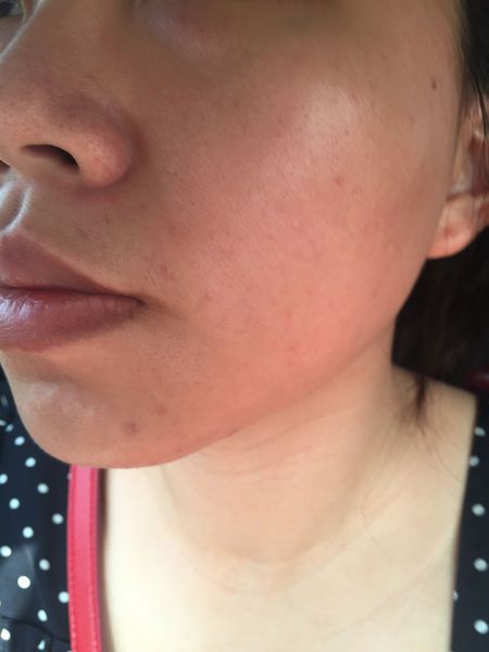 AMIINO安美諾高效抗痘凝膠