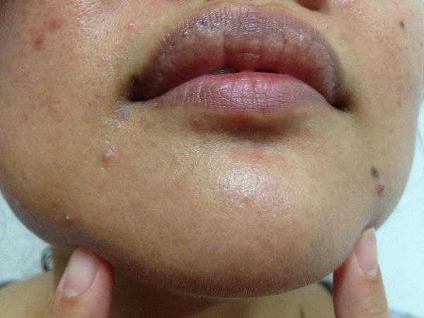 AMIINO安美諾高效抗痘凝膠