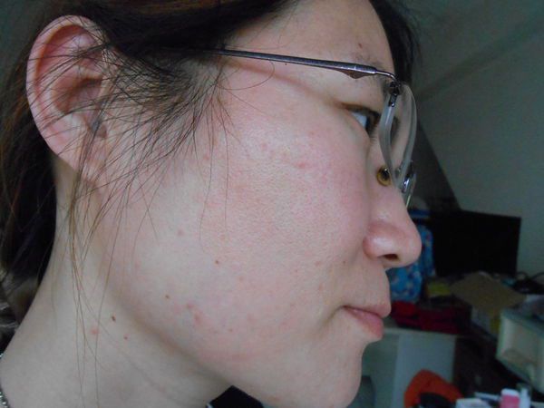 AMIINO安美諾高效抗痘凝膠