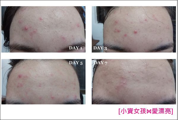 AMIINO安美諾高效抗痘凝膠