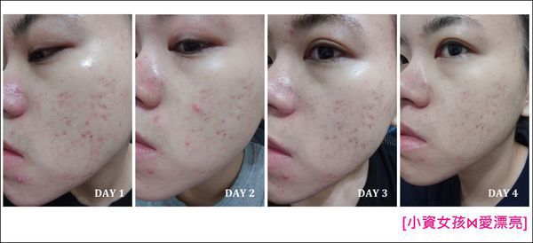 AMIINO安美諾高效抗痘凝膠