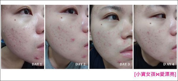 AMIINO安美諾高效抗痘凝膠