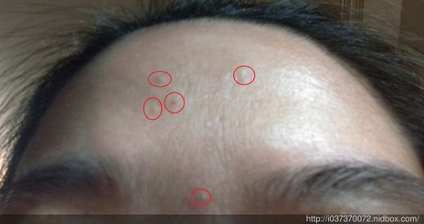 AMIINO安美諾高效抗痘凝膠