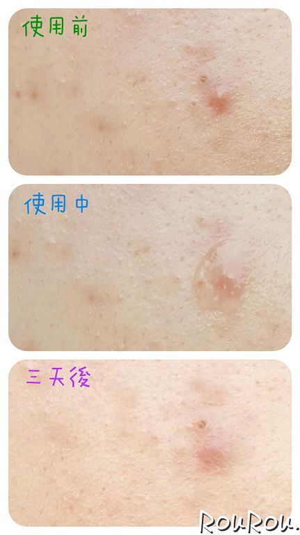 AMIINO安美諾高效抗痘凝膠