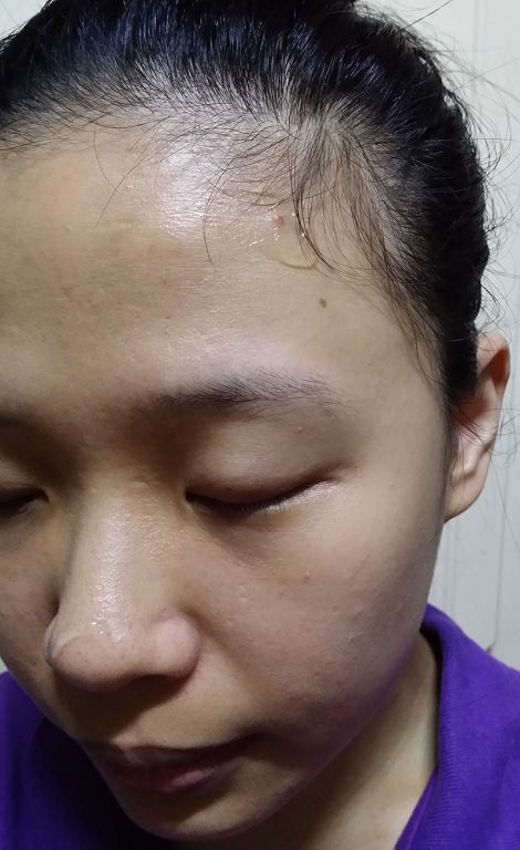 AMIINO安美諾高效抗痘凝膠