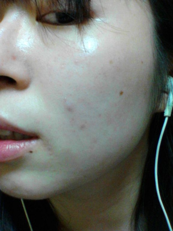 AMIINO安美諾高效抗痘凝膠