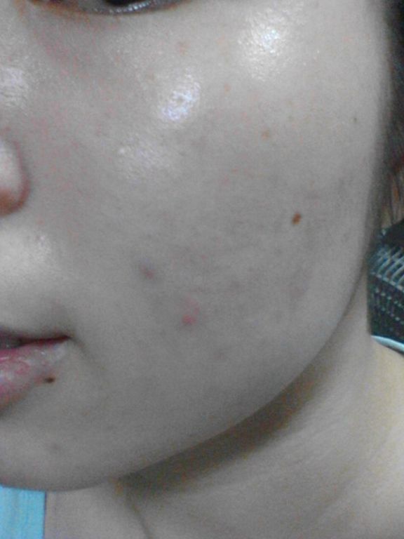 AMIINO安美諾高效抗痘凝膠