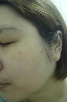 AMIINO安美諾高效抗痘凝膠