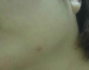 AMIINO安美諾高效抗痘凝膠