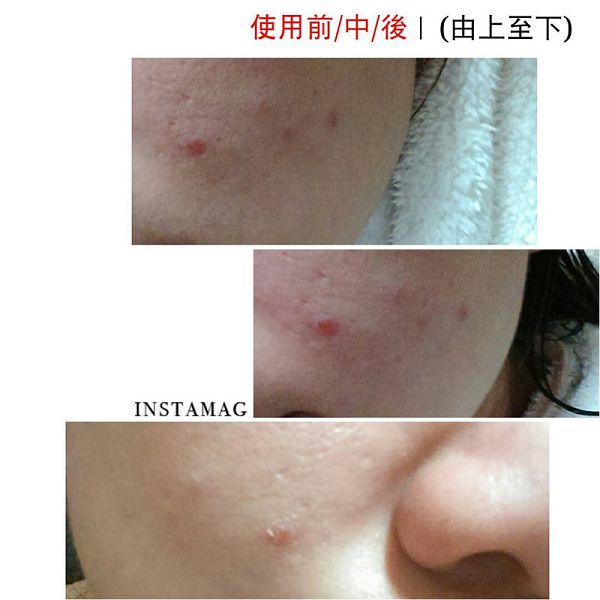 AMIINO安美諾高效抗痘凝膠