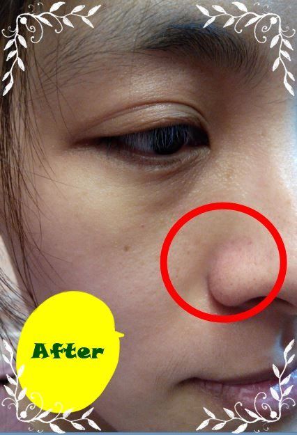 AMIINO安美諾高效抗痘凝膠