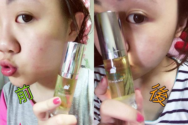 AMIINO安美諾高效抗痘凝膠