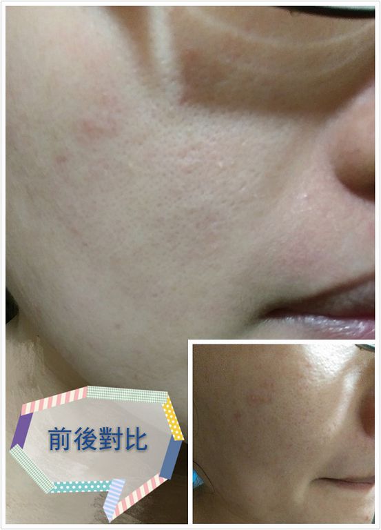 AMIINO安美諾高效抗痘凝膠