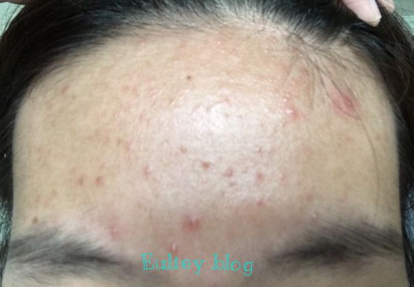 AMIINO安美諾高效抗痘凝膠