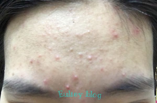 AMIINO安美諾高效抗痘凝膠