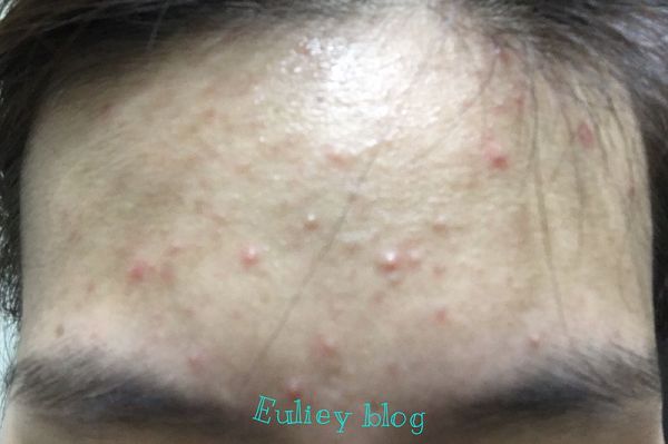 AMIINO安美諾高效抗痘凝膠