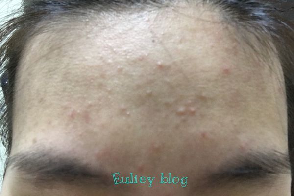 AMIINO安美諾高效抗痘凝膠