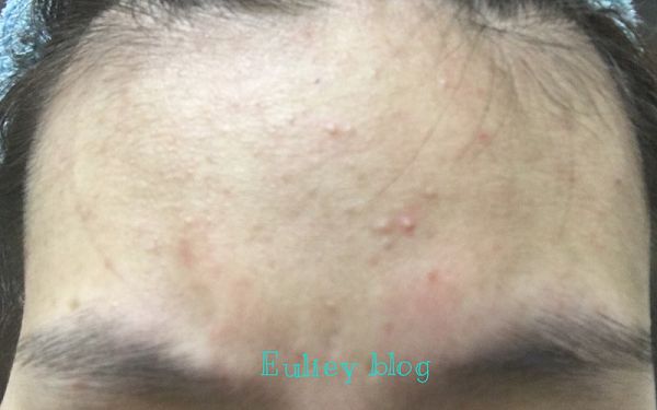 AMIINO安美諾高效抗痘凝膠