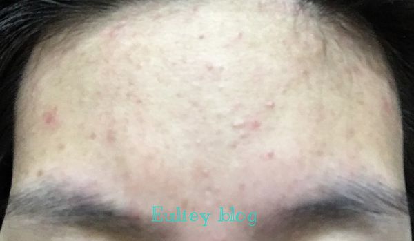 AMIINO安美諾高效抗痘凝膠